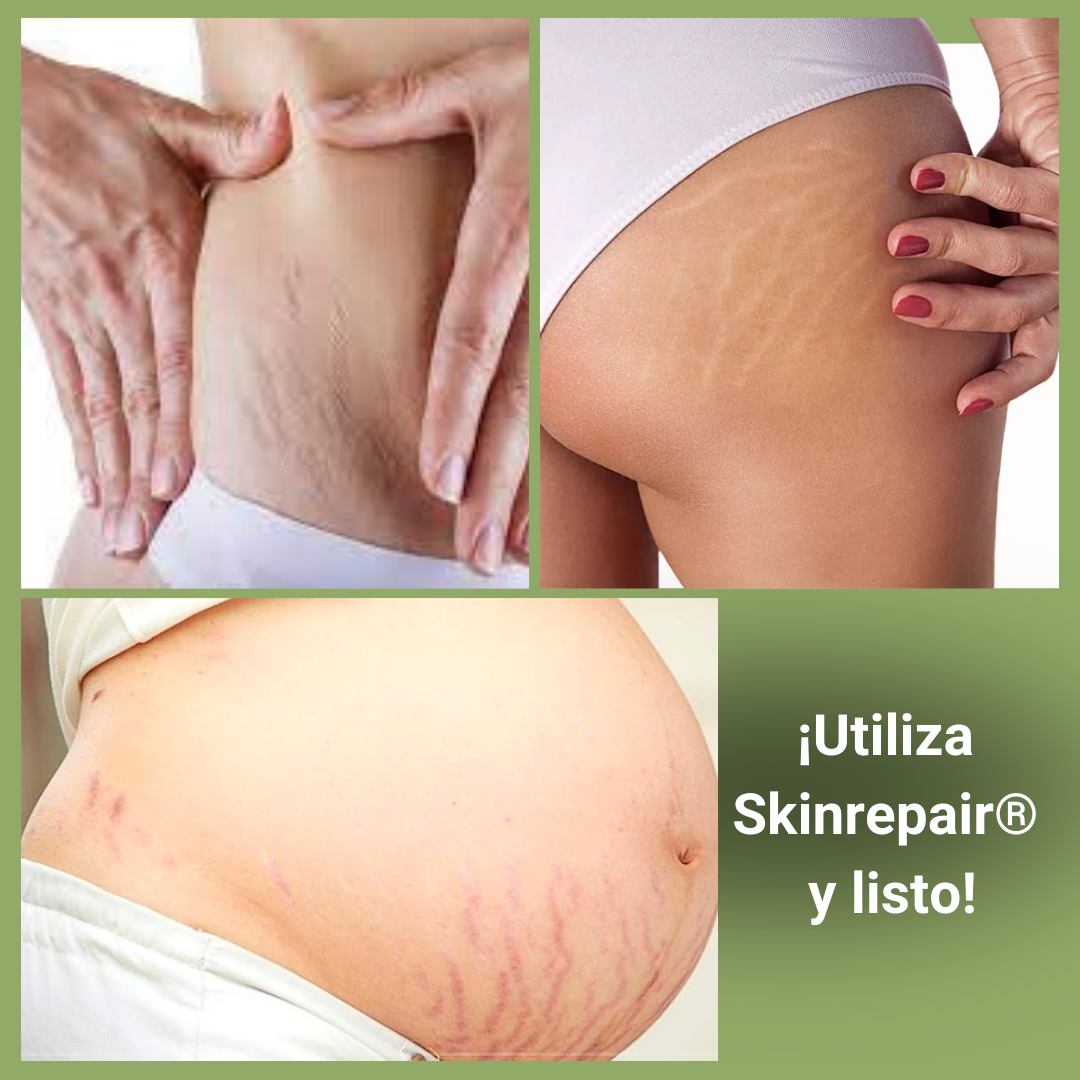 SkinRepair® Crema reafirmante antiestrías - reduce la apariencia y relieve💥HOY 50% DCTO