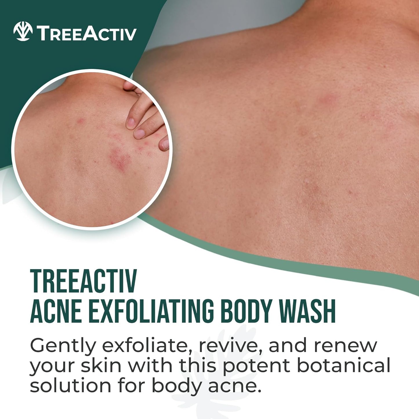 Jabón Exfoliante para el acné corporal✨Alivia y previene brotes - HOY CON 50% DCTO